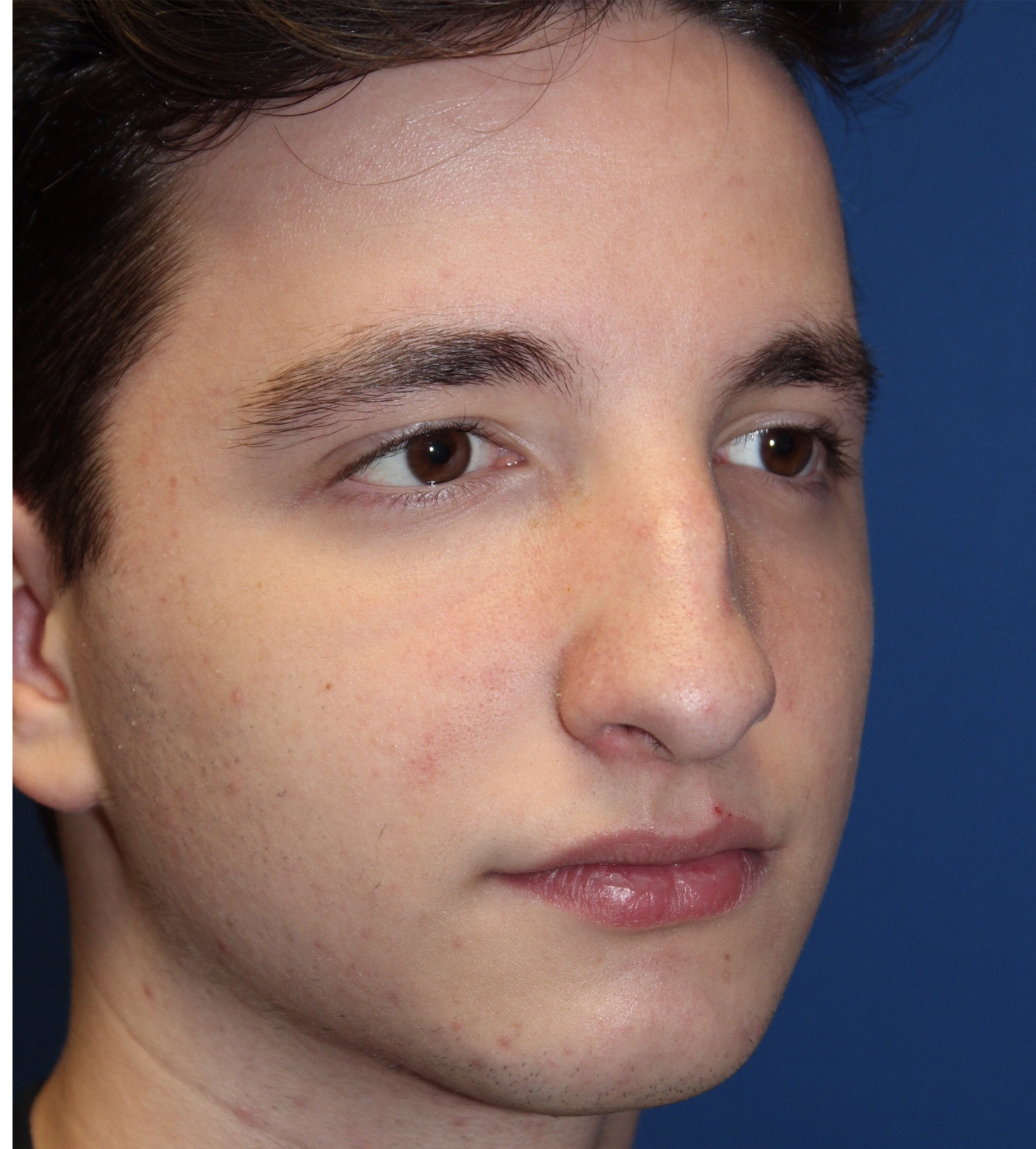 Male Cosmetic Rhinoplasty