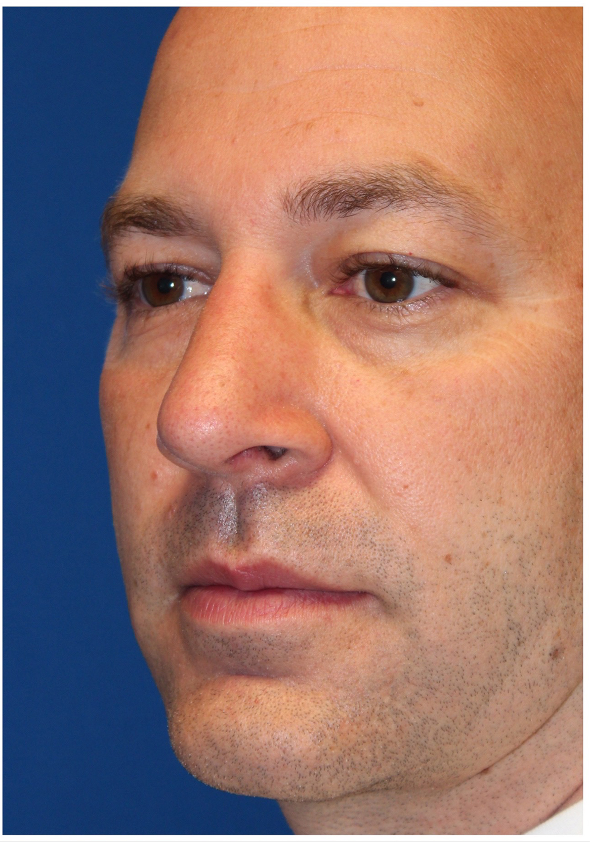 Male Cosmetic Rhinoplasty