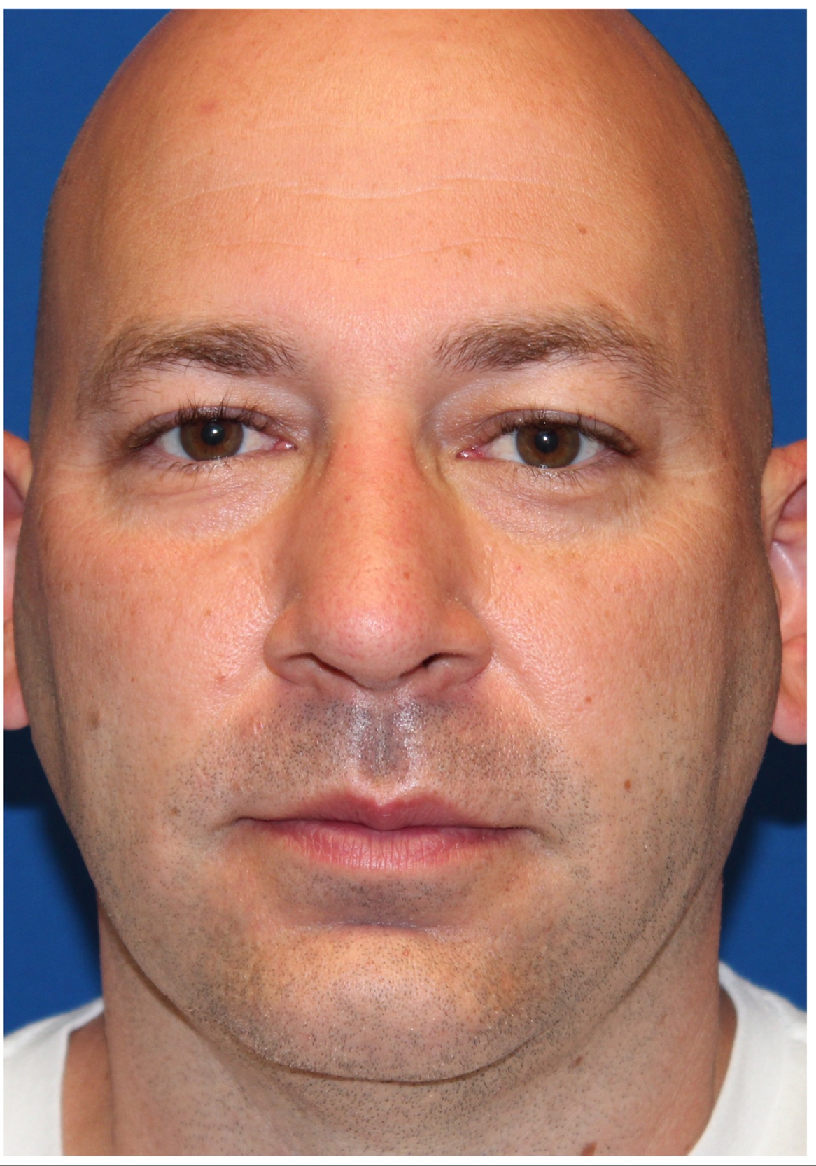 Male Cosmetic Rhinoplasty