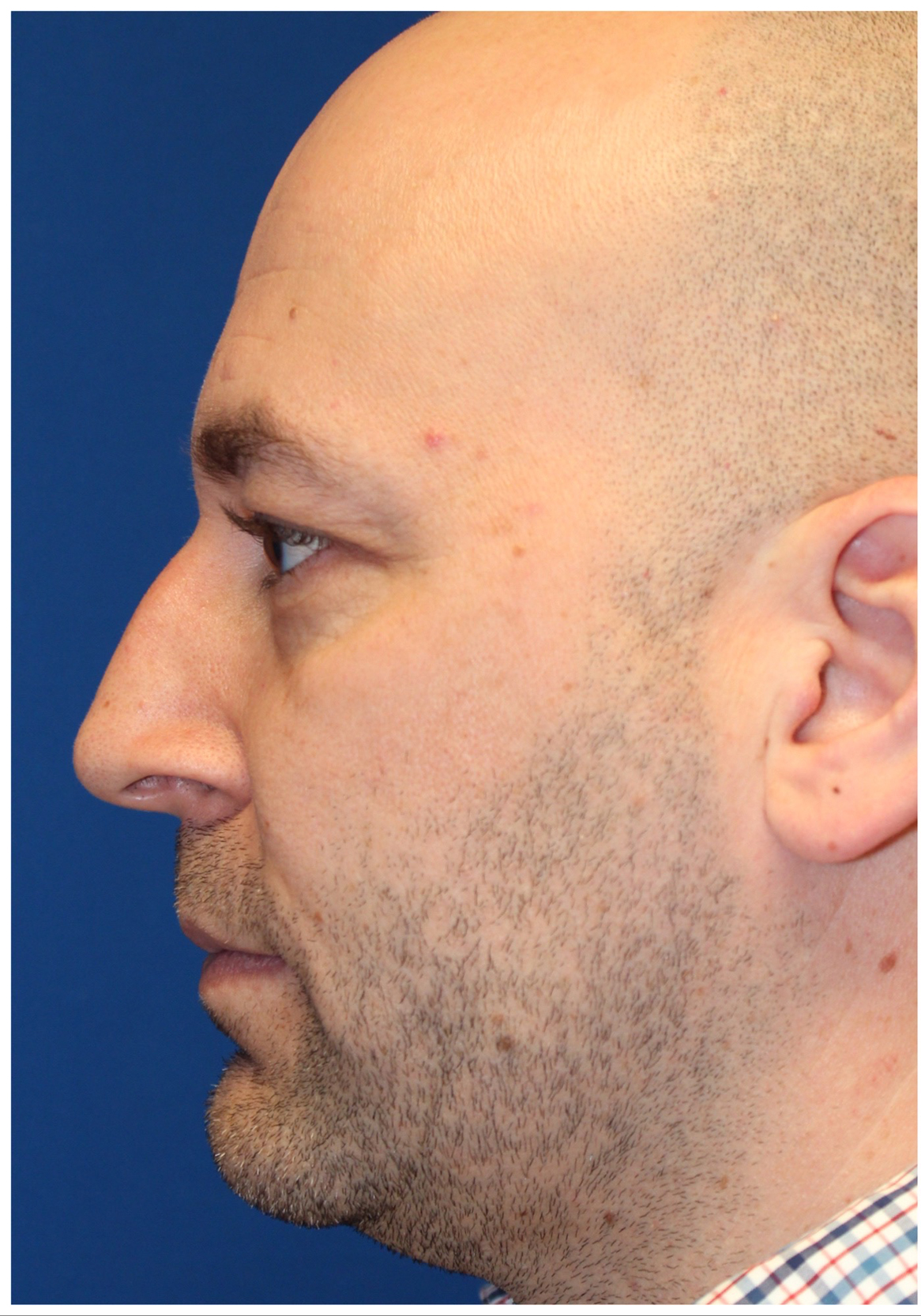 Male Cosmetic Rhinoplasty