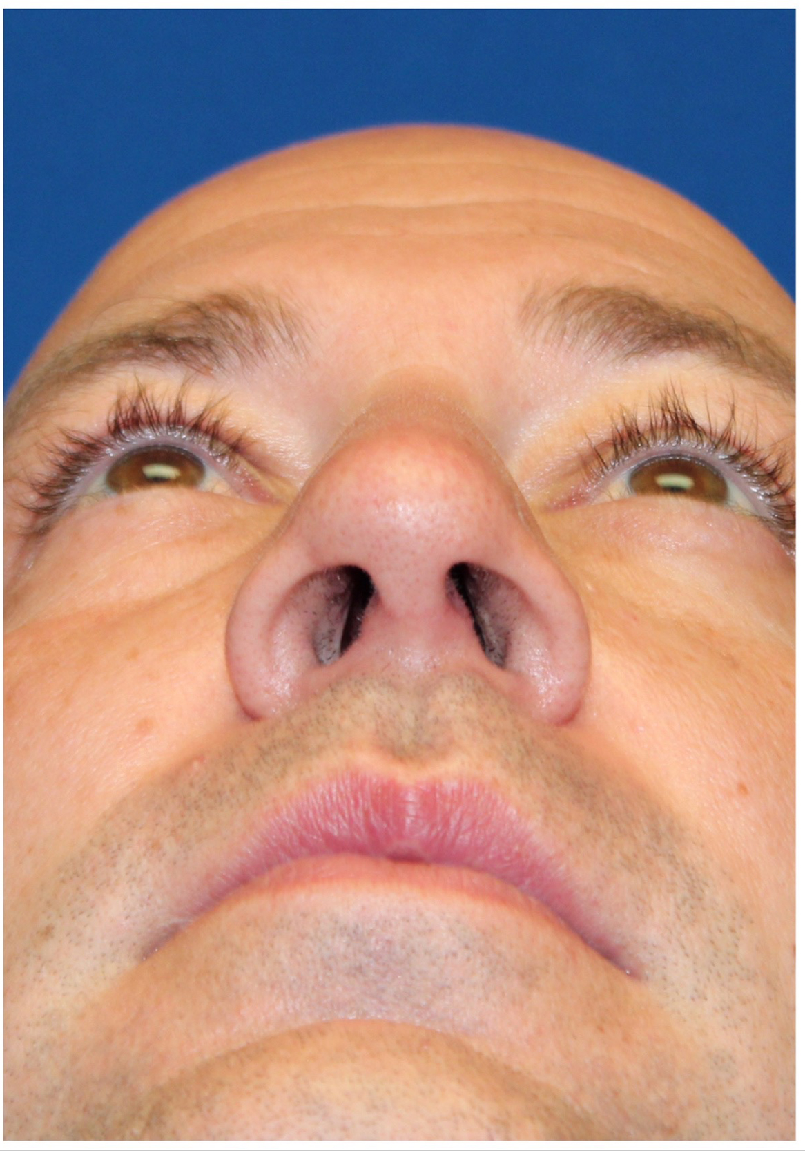 Male Cosmetic Rhinoplasty