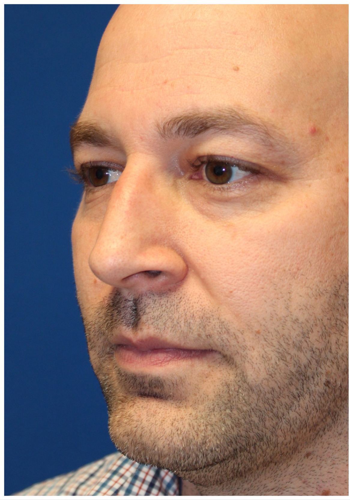 Male Cosmetic Rhinoplasty