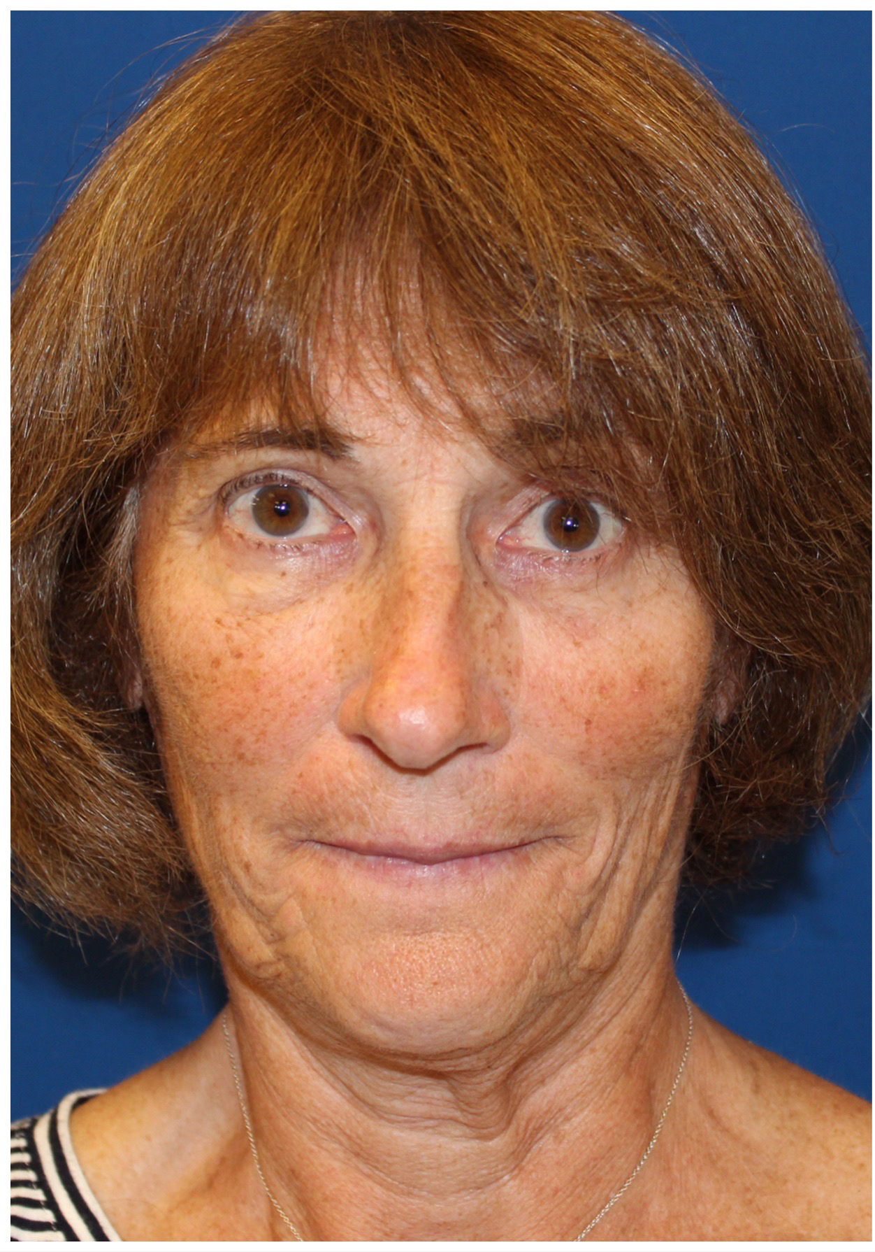 Female Cosmetic Rhinoplasty