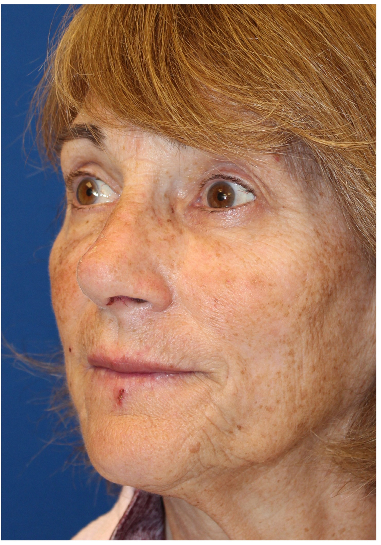 Female Cosmetic Rhinoplasty