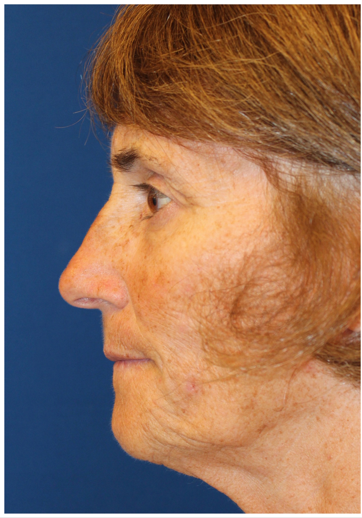 Female Cosmetic Rhinoplasty