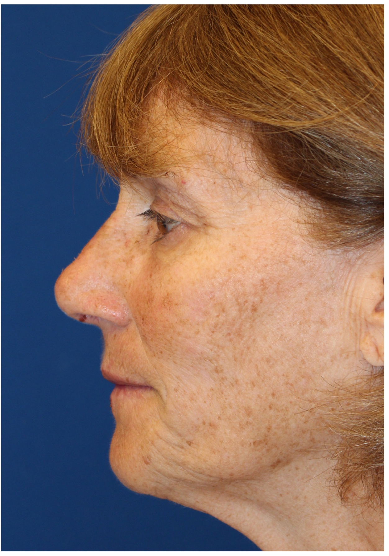 Female Cosmetic Rhinoplasty