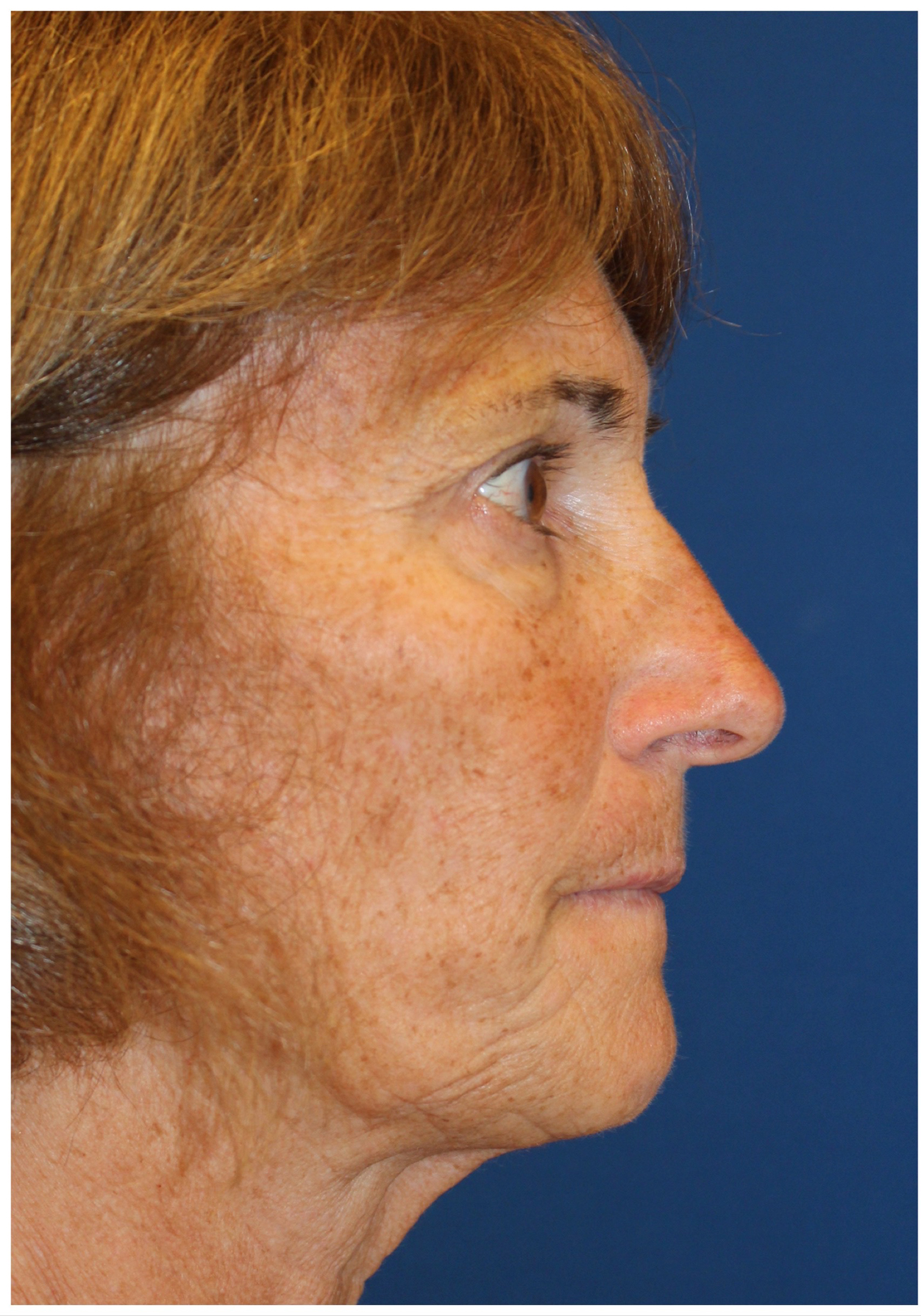 Female Cosmetic Rhinoplasty