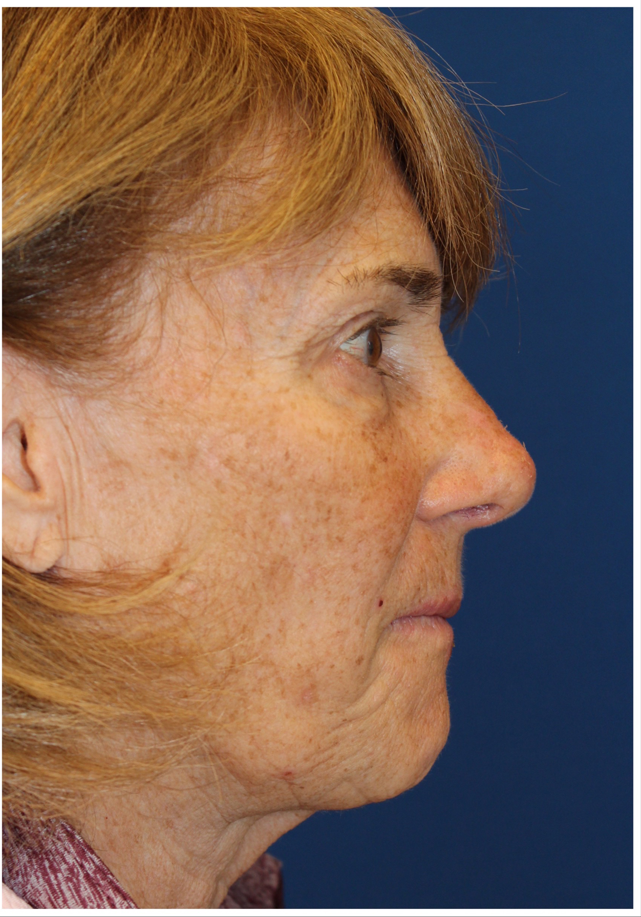 Female Cosmetic Rhinoplasty