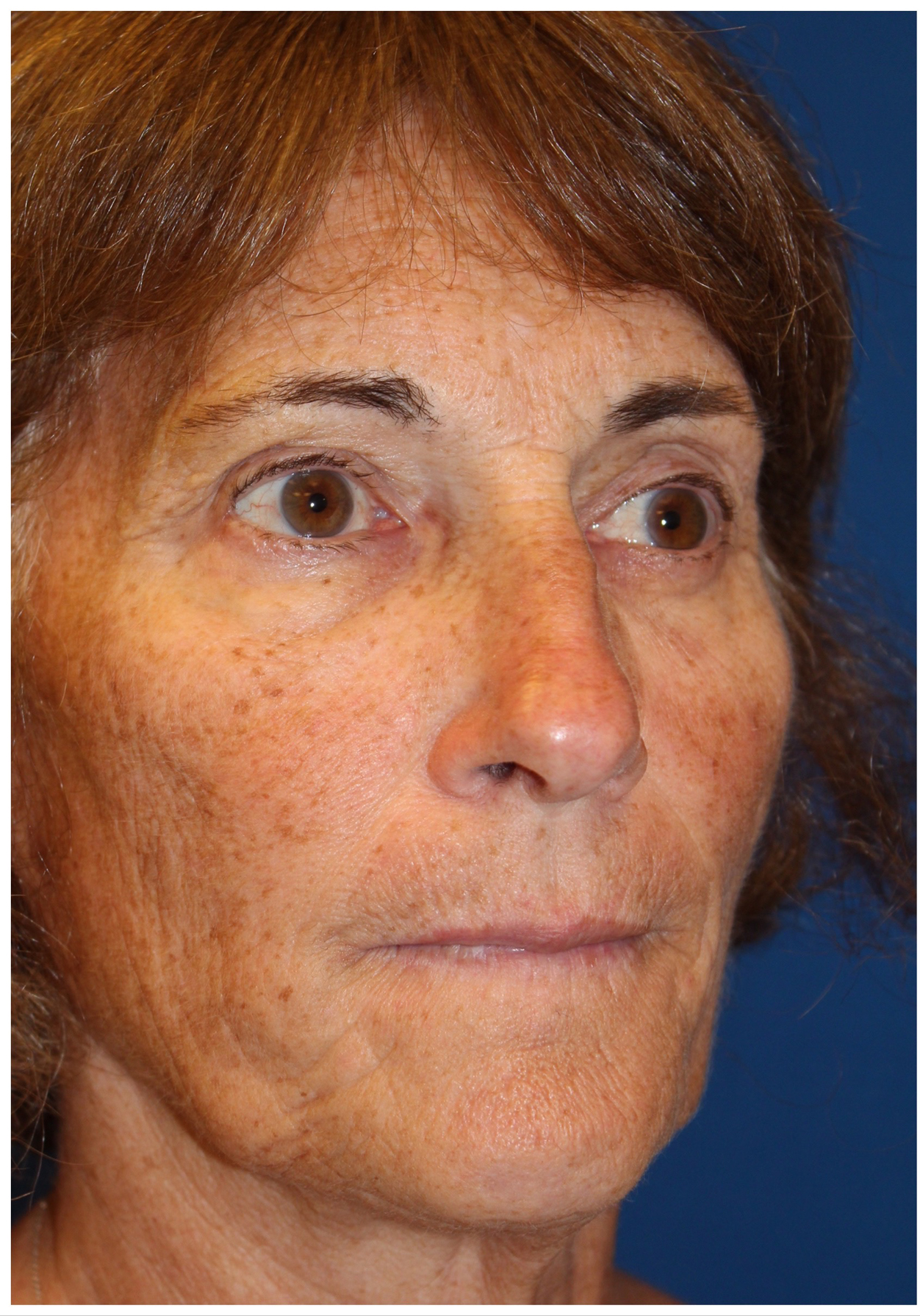 Female Cosmetic Rhinoplasty