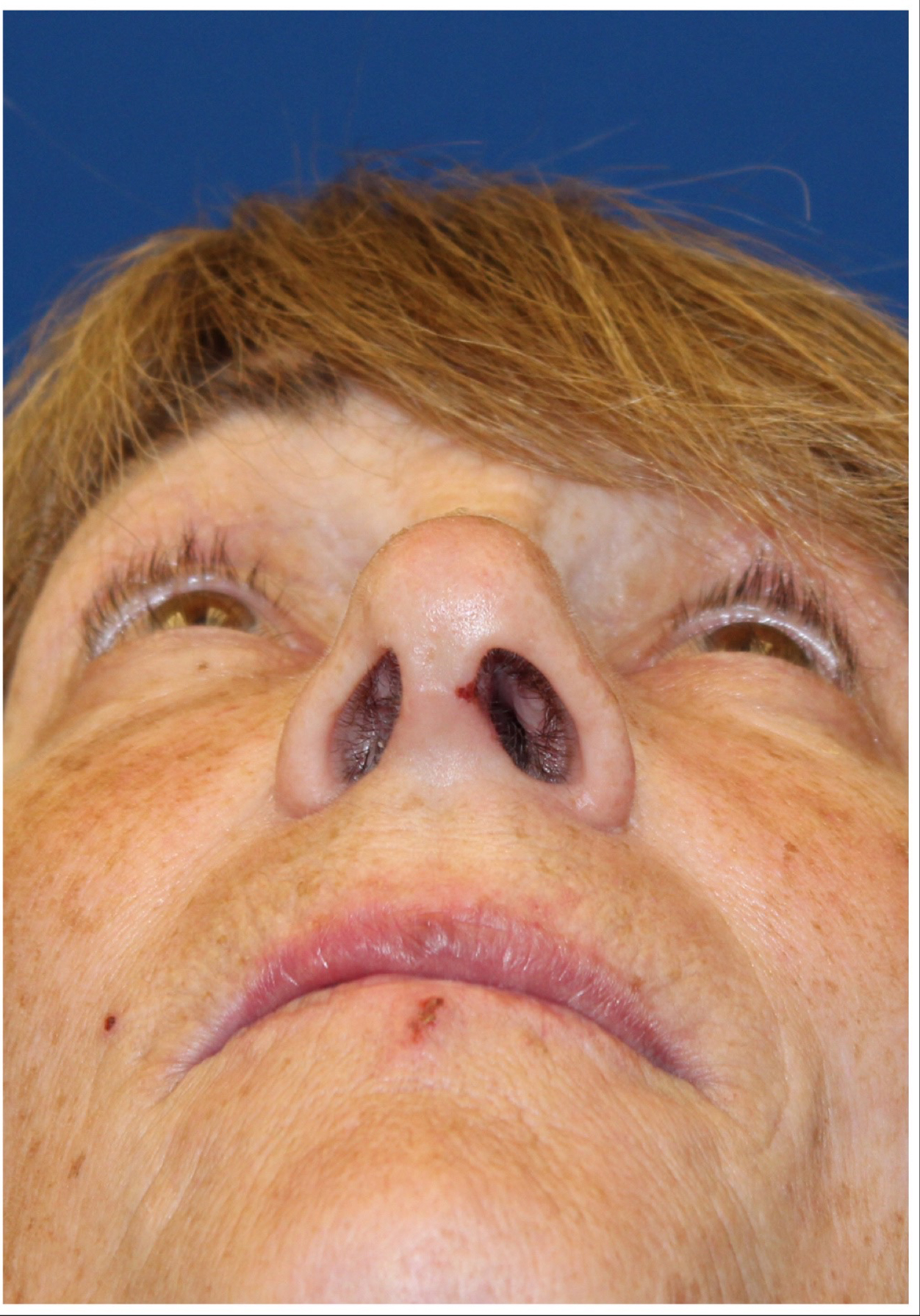 Female Cosmetic Rhinoplasty