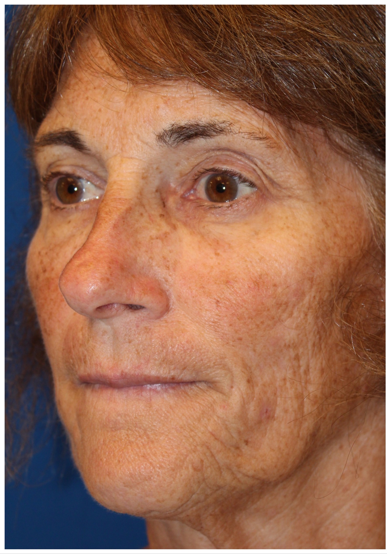 Female Cosmetic Rhinoplasty