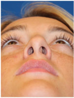 Female Cosmetic Rhinoplasty