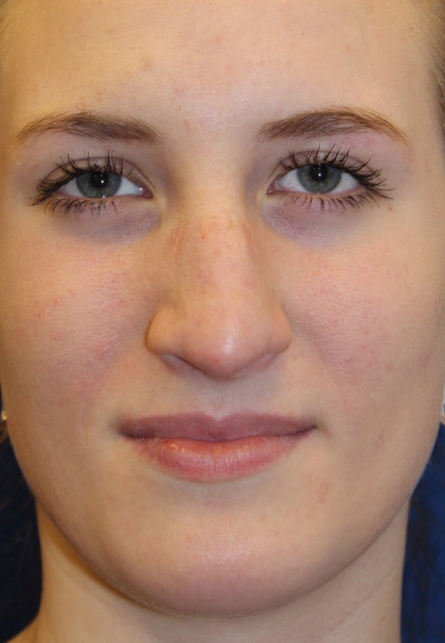 Female Revision Rhinoplasty