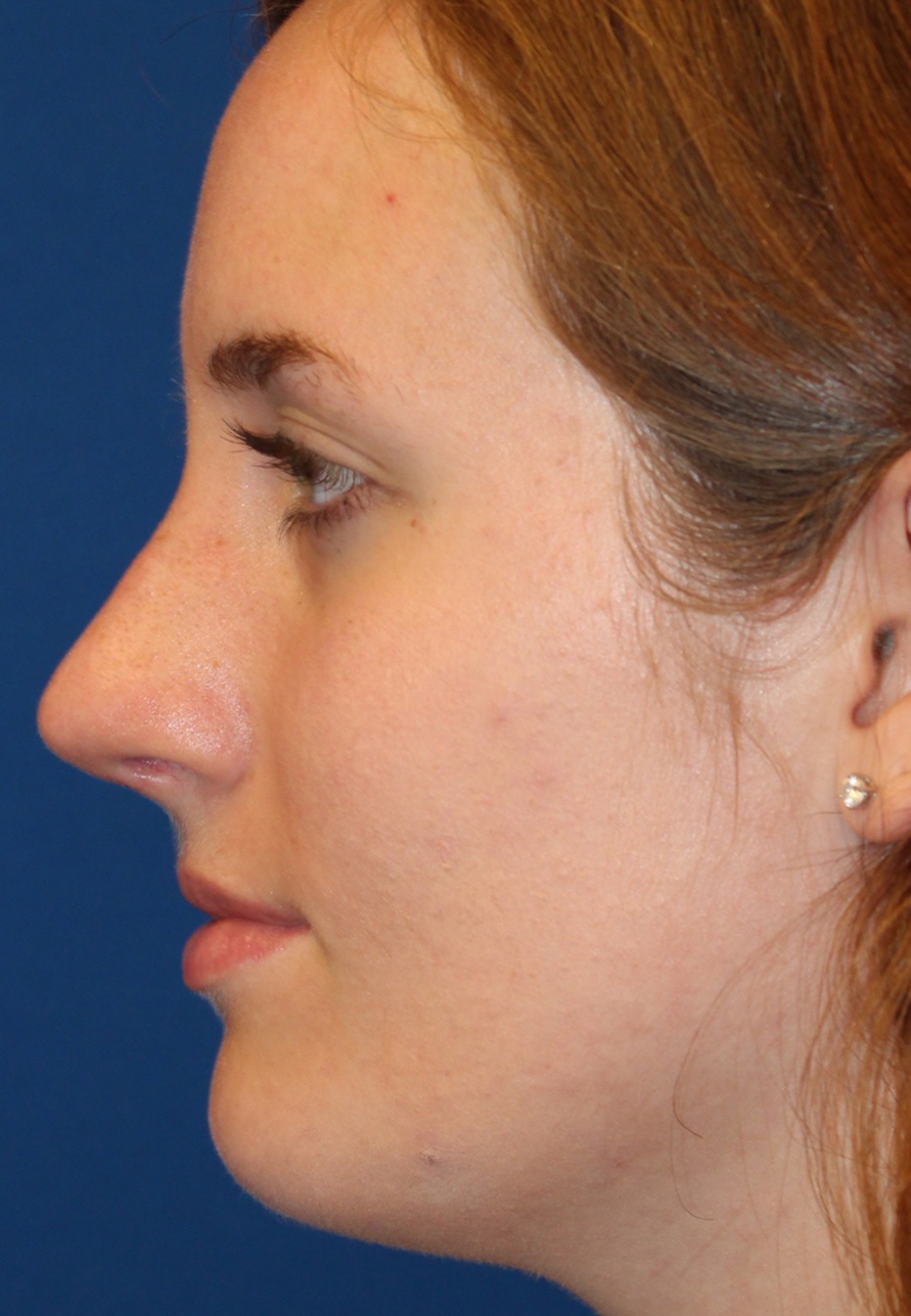 Female Revision Rhinoplasty