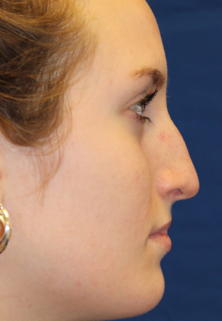 Female Revision Rhinoplasty