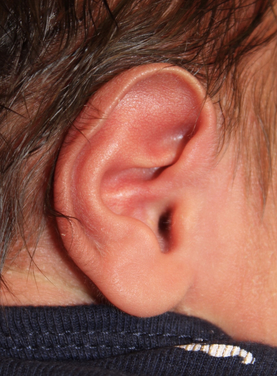 Ear Reshaping