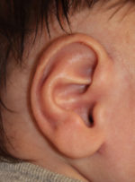 Ear Reshaping