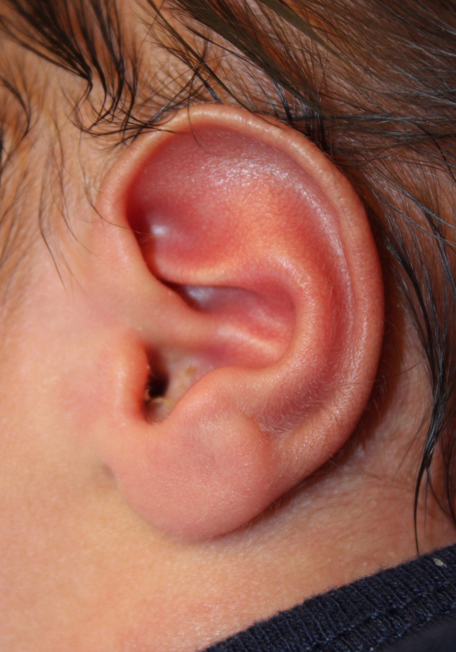 Ear Reshaping