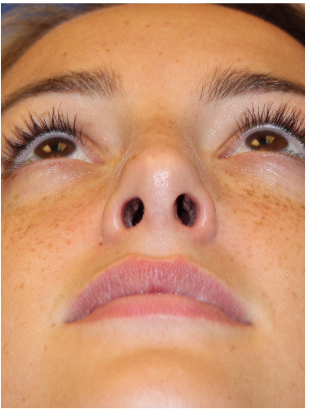 Female Cosmetic Rhinoplasty