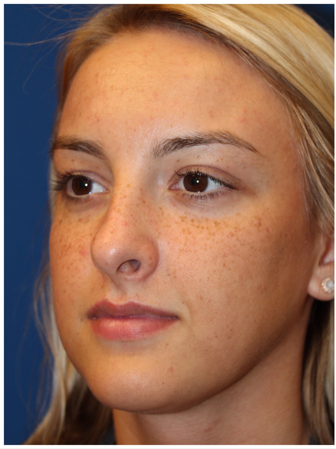 Female Cosmetic Rhinoplasty