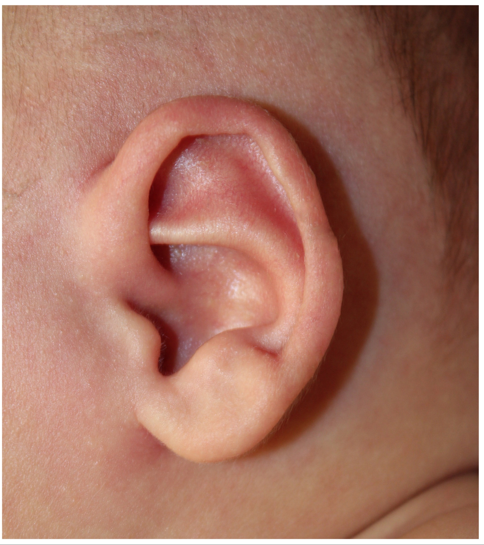 Ear Reshaping