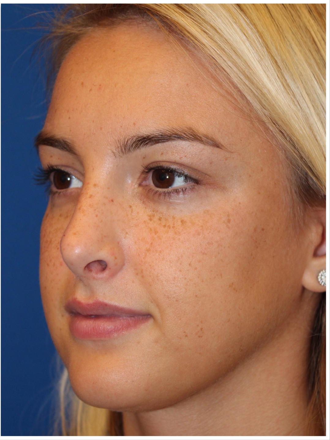 Female Cosmetic Rhinoplasty