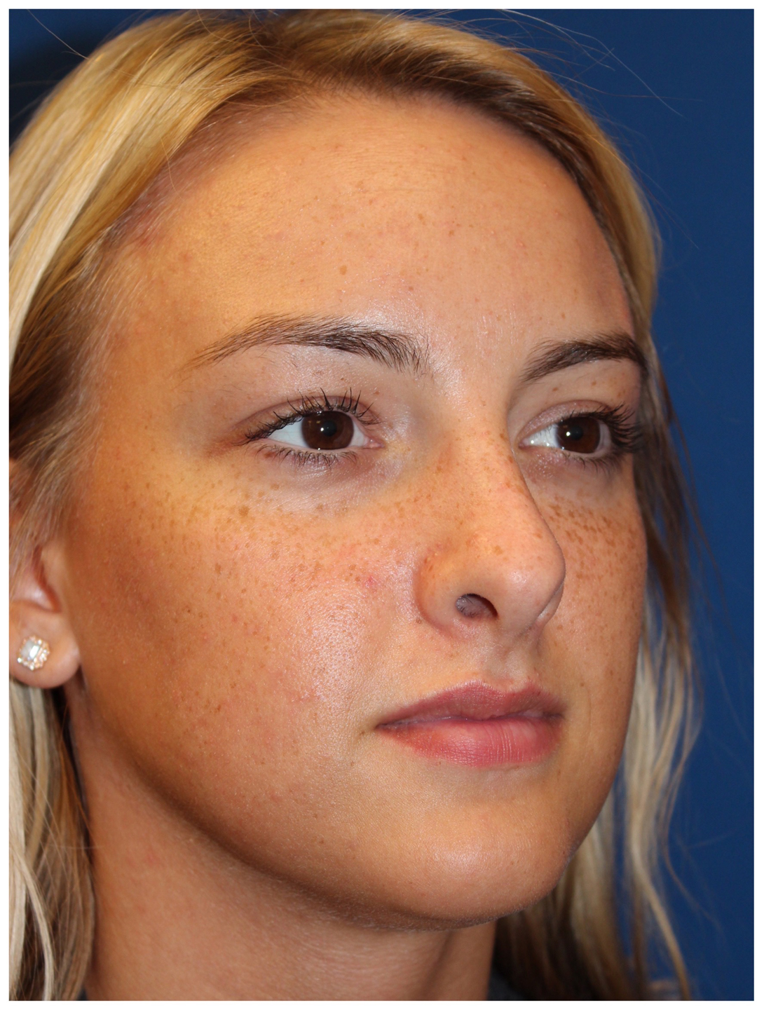 Female Cosmetic Rhinoplasty