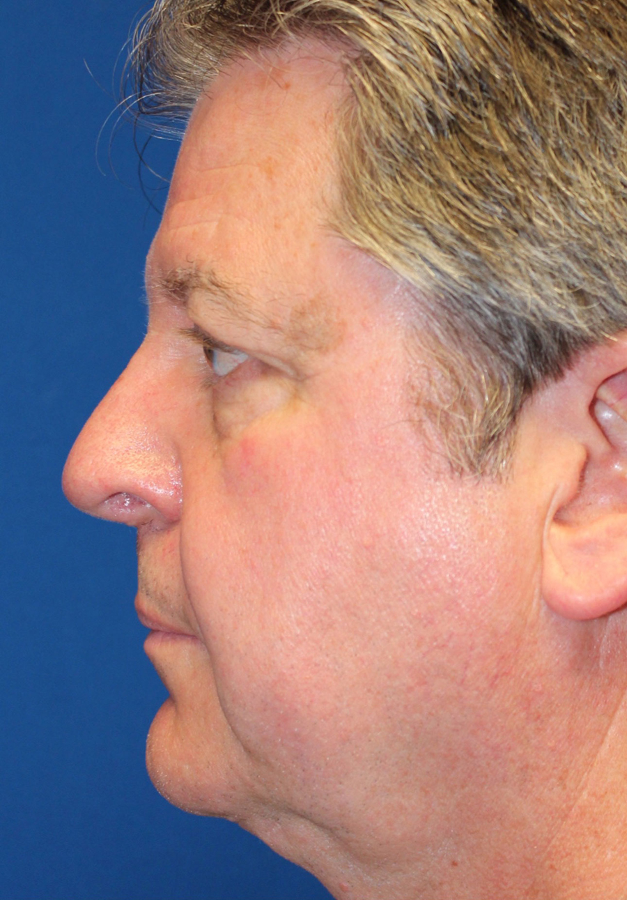 Male Functional Rhinoplasty