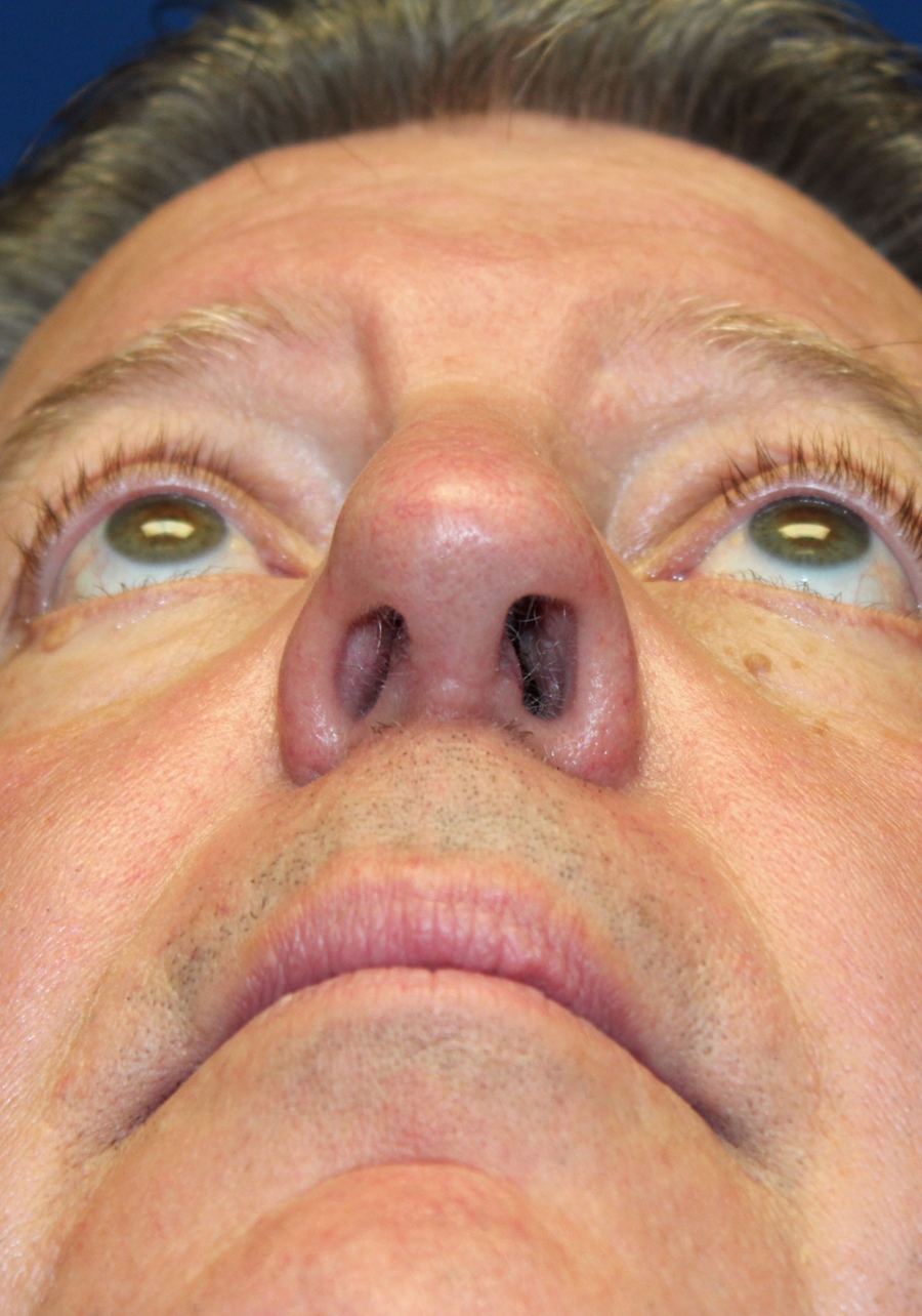 Male Functional Rhinoplasty