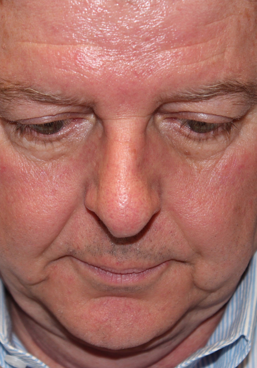 Male Functional Rhinoplasty