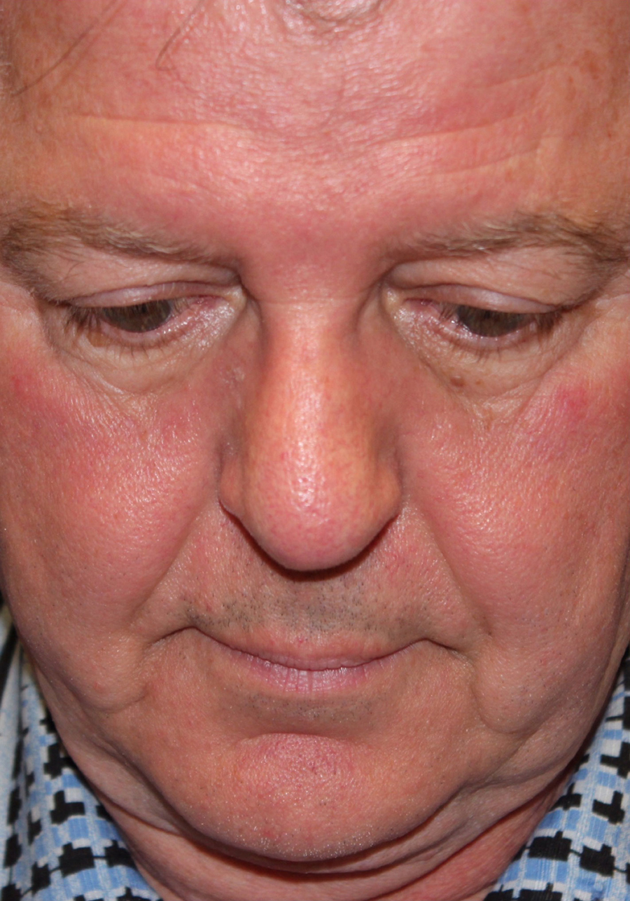 Male Functional Rhinoplasty