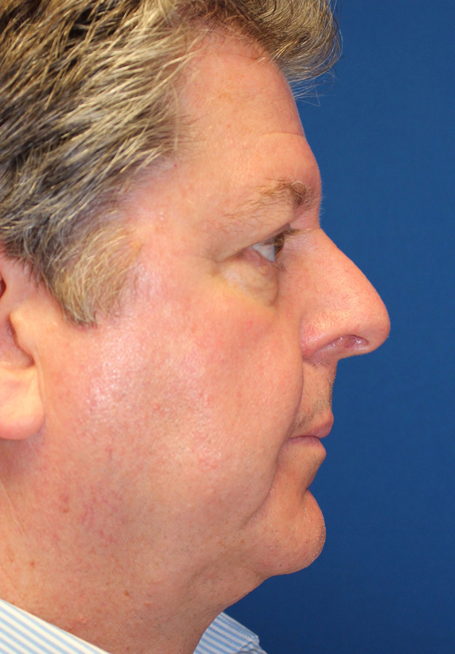 Male Functional Rhinoplasty