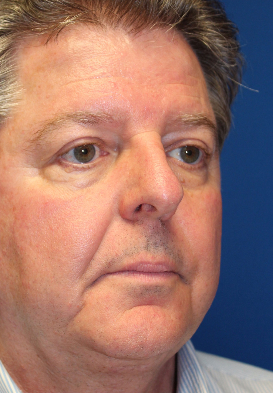 Male Functional Rhinoplasty