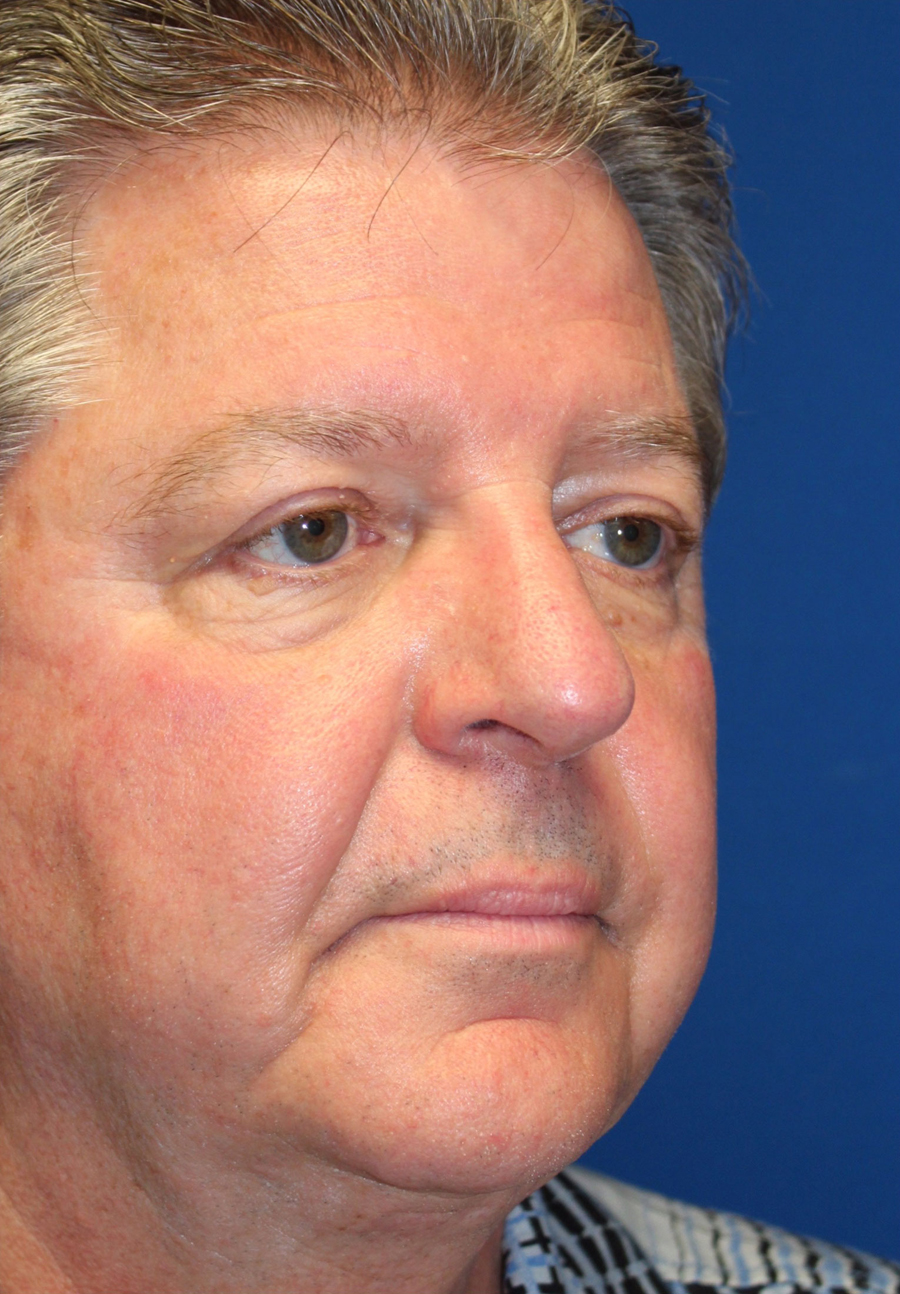 Male Functional Rhinoplasty