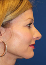 Female Revision Rhinoplasty