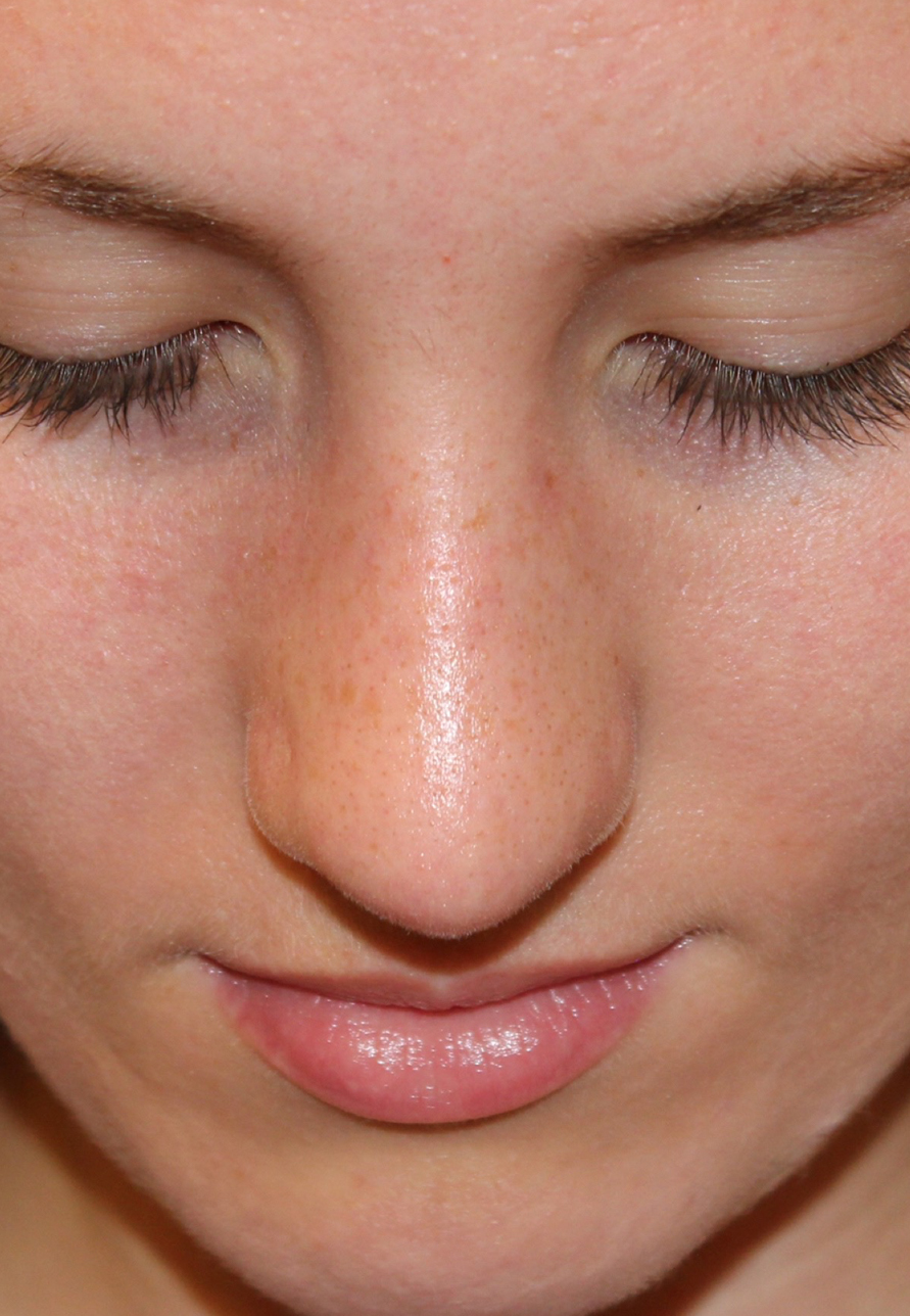 Female Revision Rhinoplasty