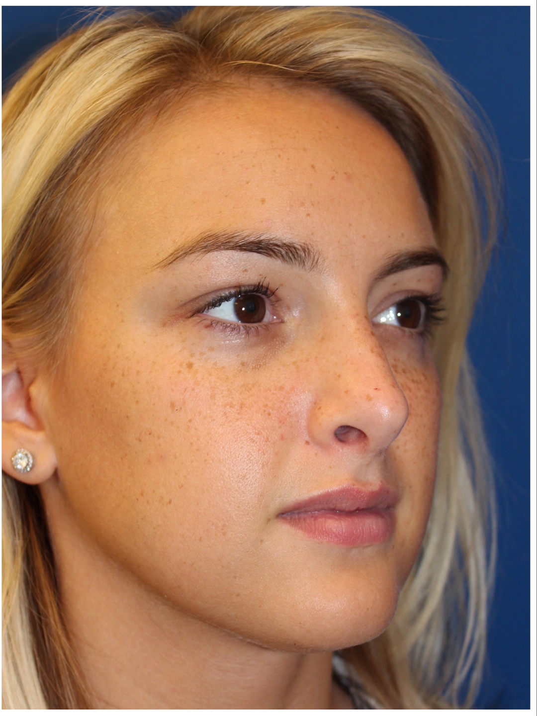 Female Cosmetic Rhinoplasty