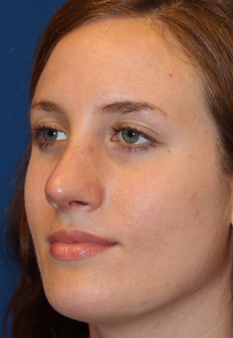 Female Revision Rhinoplasty