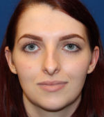 Female Cosmetic Rhinoplasty