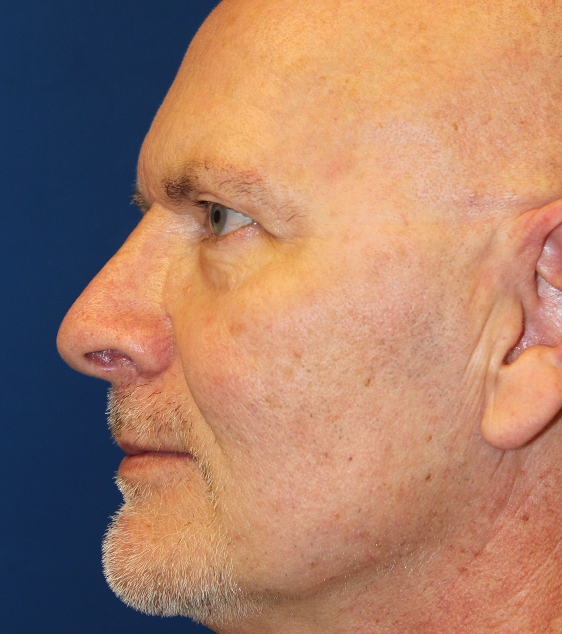 Male Cosmetic Rhinoplasty