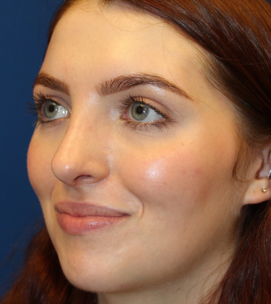 Female Cosmetic Rhinoplasty