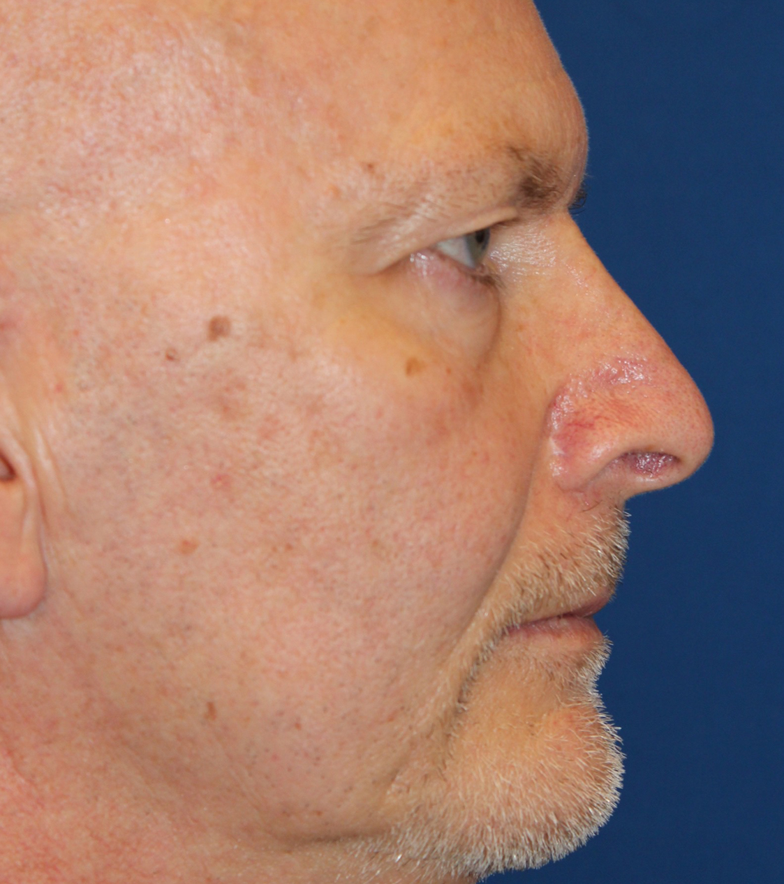 Male Cosmetic Rhinoplasty