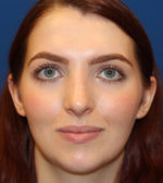 Female Cosmetic Rhinoplasty