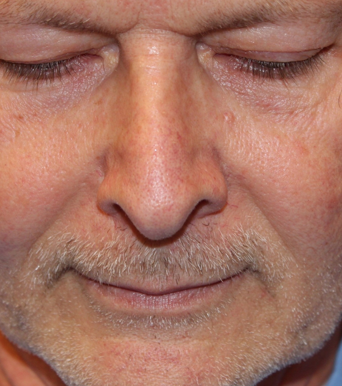 Male Cosmetic Rhinoplasty