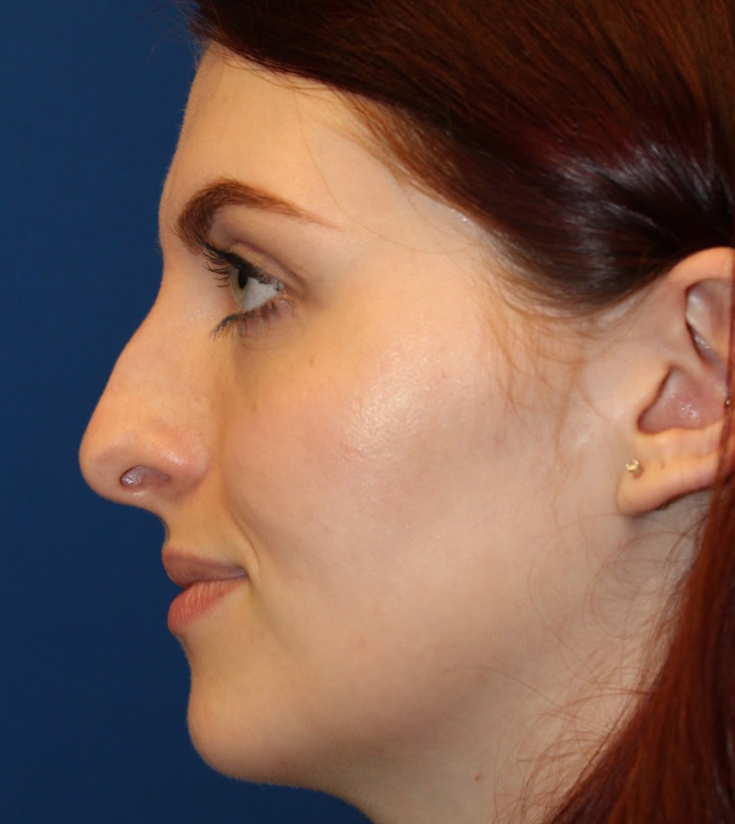 Female Cosmetic Rhinoplasty