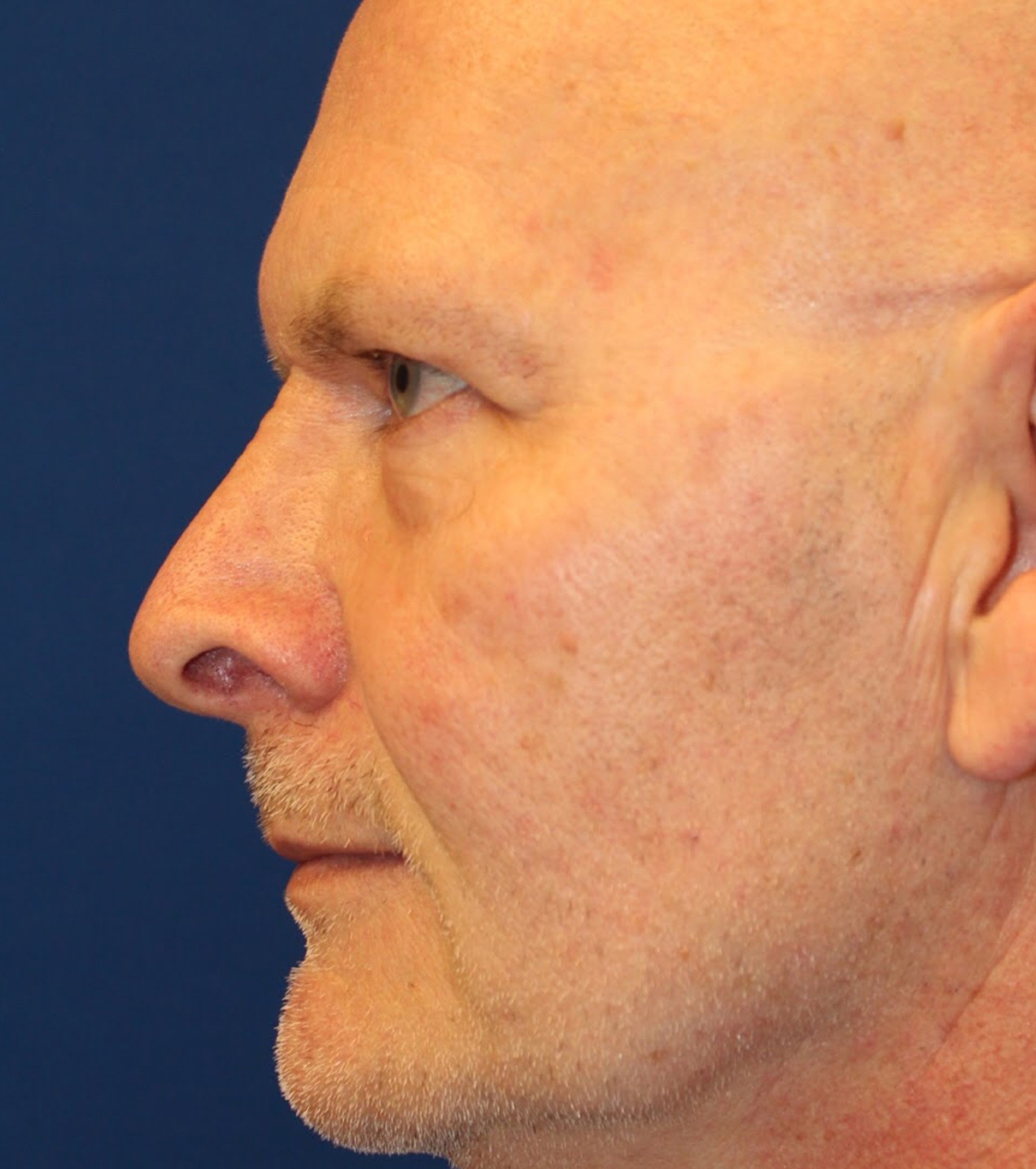 Male Cosmetic Rhinoplasty