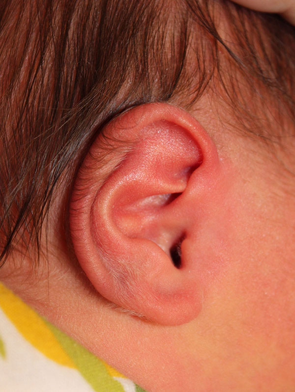 Ear Reshaping