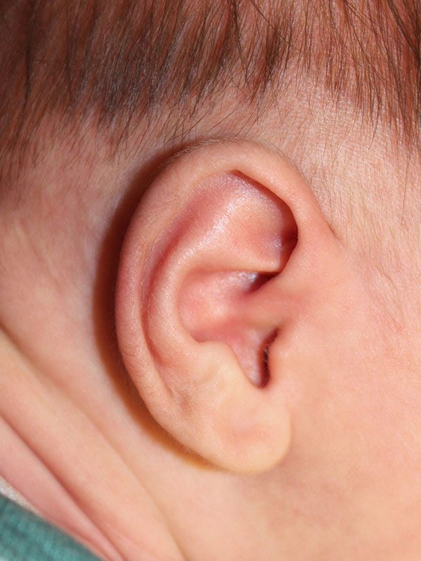 Ear Reshaping