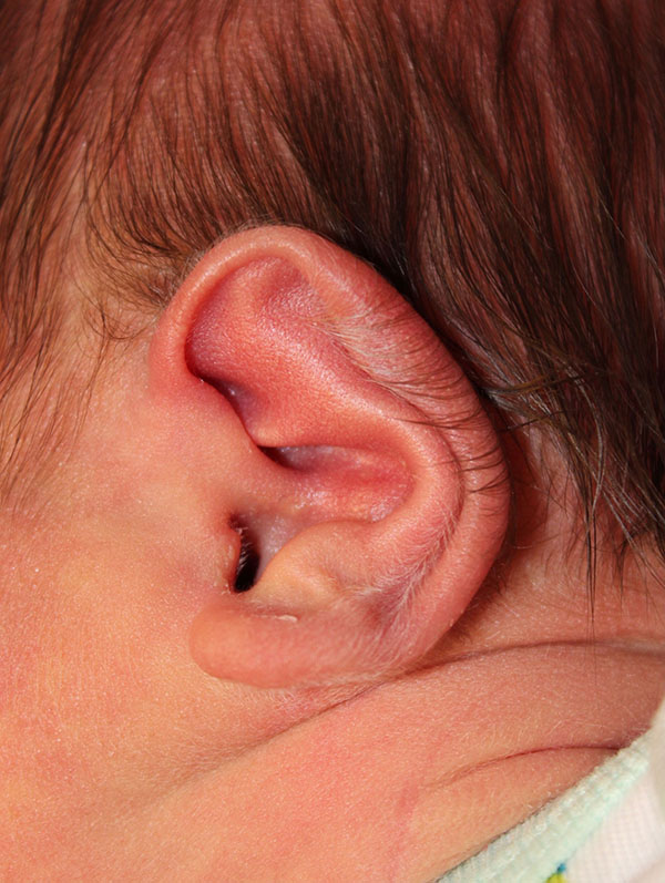 Ear Reshaping