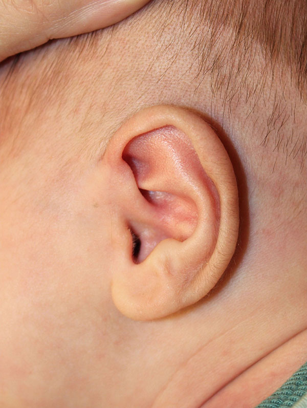 Ear Reshaping